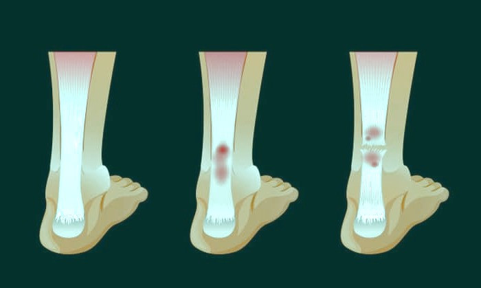 انواع شکستگی استخوان شکستگی بسته