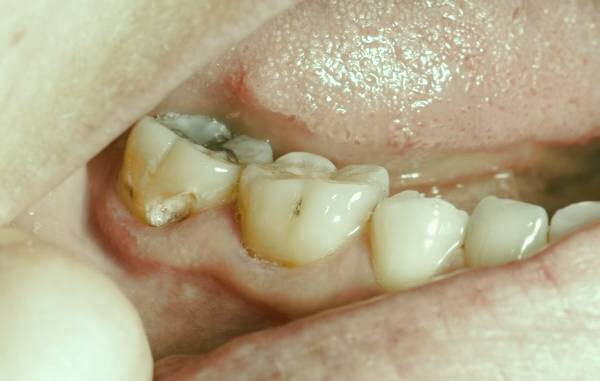 دلیل پوسیدگی دندان