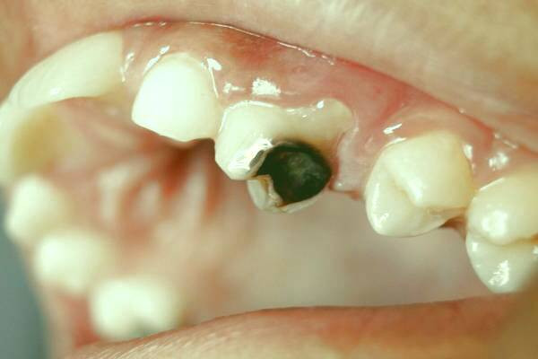 پوسیدگی دندان