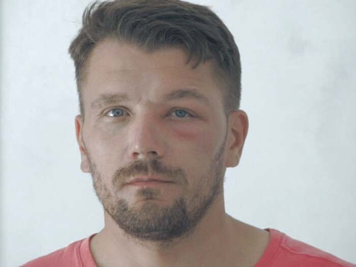 تورم زیر چشم