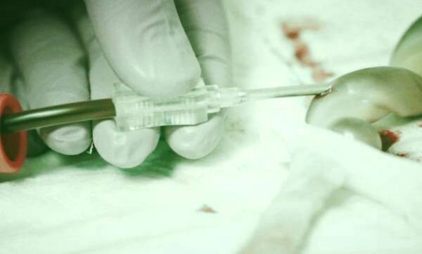 سرنگ خون بند ناف