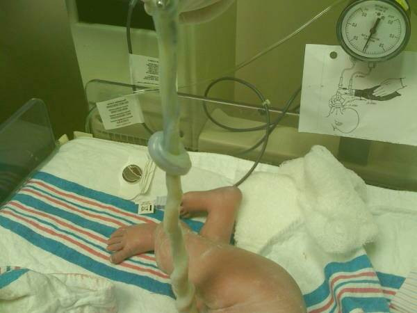 اهدای خون بند ناف