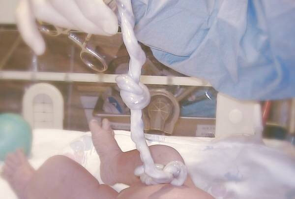 فایده خون بند ناف