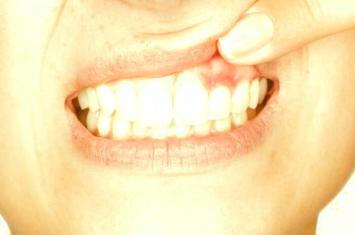 قرمزی و عفونت ایمپلنت