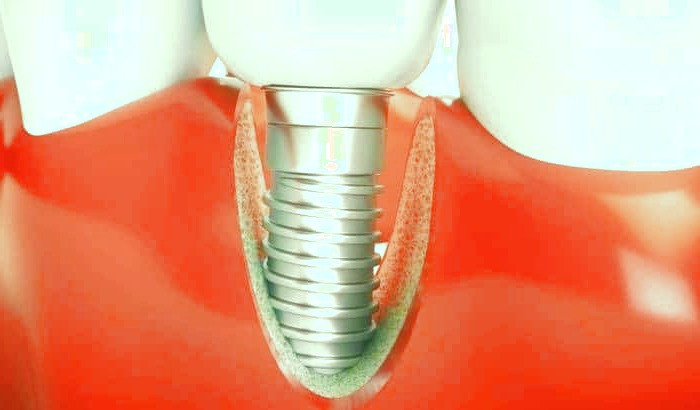 پری ایمپلنت یا ایمپلنتایتیس