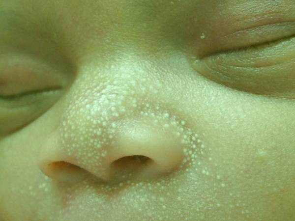 جوش های سفید زیر پوستی یا میلیا در نوزادان چه علتی دارد؟ جوش های سفید زیر پوستی در نوزادان