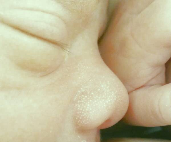 دلایل ایجاد جوش های سفید زیر پوستی یا میلیا در نوزادان میلیا در نوزادان