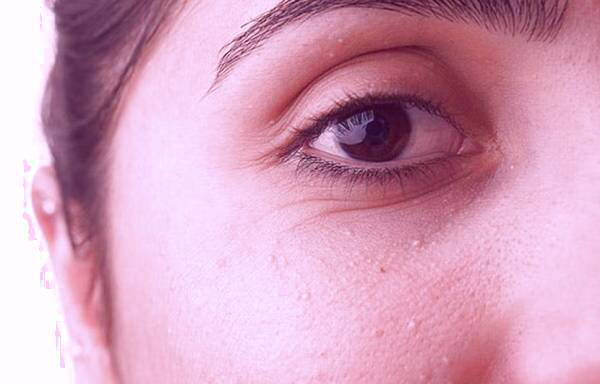 انواع جوش های سفید زیر پوستی یا میلیا انواع جوش های سفید زیر پوستی