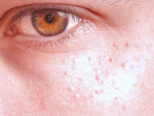 از علت تا درمان جوش های سفید زیر پوستی یا میلیا جوش های سفید زیر پوستی یا میلیا