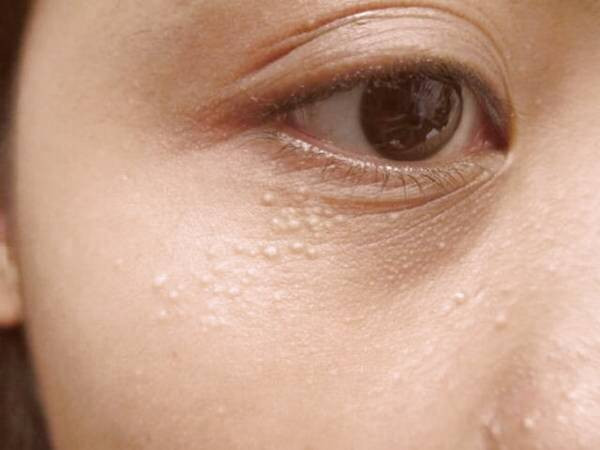 علل گوناگون جوش های سفید زیر پوستی یا میلیا علل جوش های سفید زیر پوستی یا میلیا