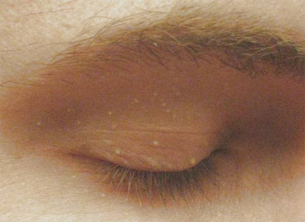 روش های جلوگیری از جوش های سفید زیر پوستی یا میلیا جلوگیری از جوش های سفید زیر پوستی یا میلیا