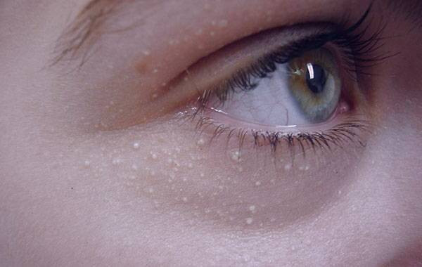 درمان جوش های سفید زیر پوستی یا میلیا در طب مدرن درمان جوش های سفید زیر پوستی در طب مدرن