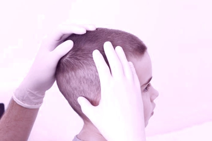 اختلال کندن موی سر کچلی کودک