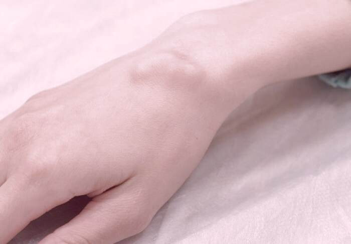 تمام آنچه باید درباره بورسیت بدانید انواع بورسیت