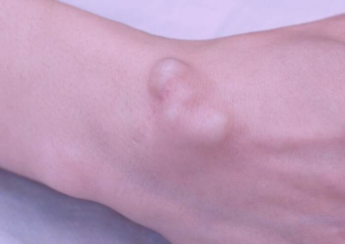 علت و علائم التهاب بورس بورسیت آرنج