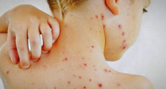 احتمال ابتلا به زونا در چه کسانی بیشتری است ؟ بیماری زونا