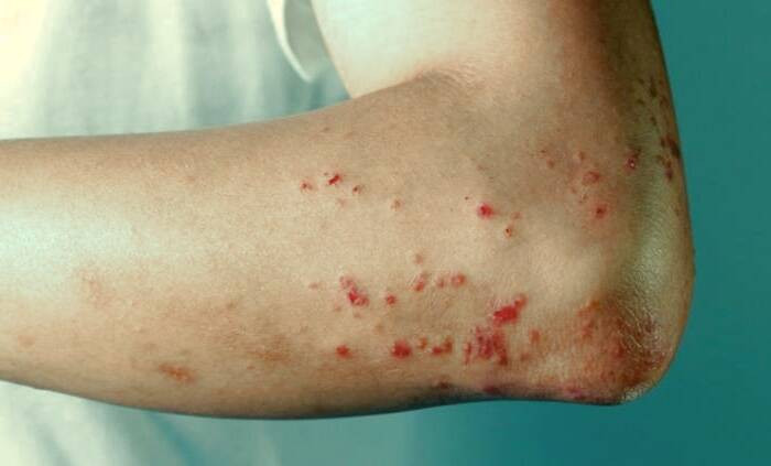 درمان زونا در کودکان تشخیص زونا