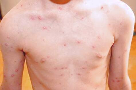 علت زونا در کودکان درمان زونا در کودکان