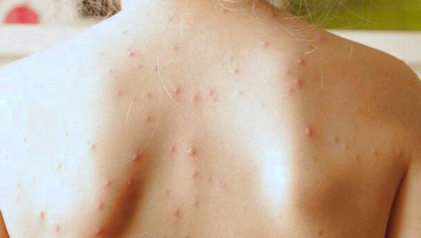 زونا در کودکان زونا چیست