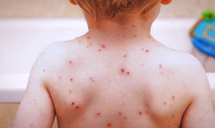 زونا چیست علت زونا در کودکان