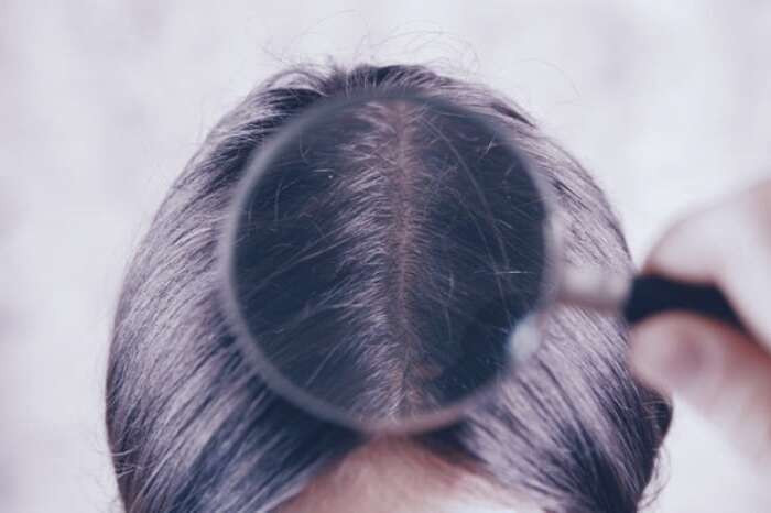 باکتری روی پوست سر شوره سر