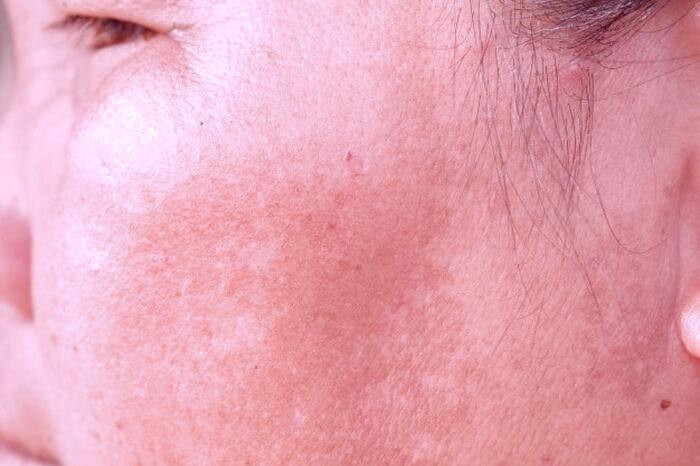 میکروب روی پوست صورت پوست صورت