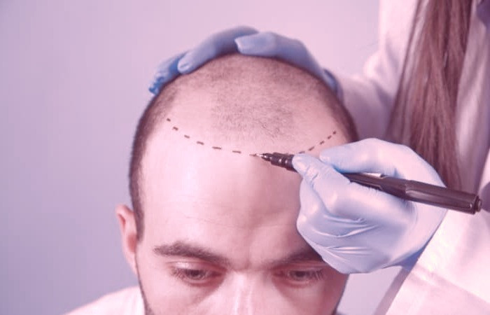 کاشت مو برای زیبایی بیشتر