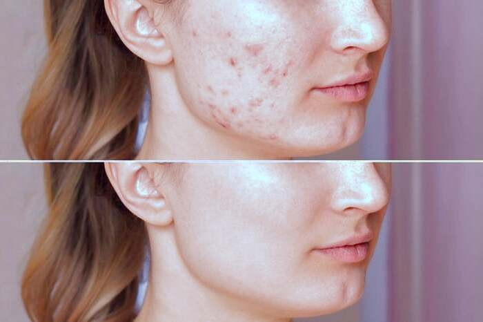 رفع جوش های روی پوست صورت