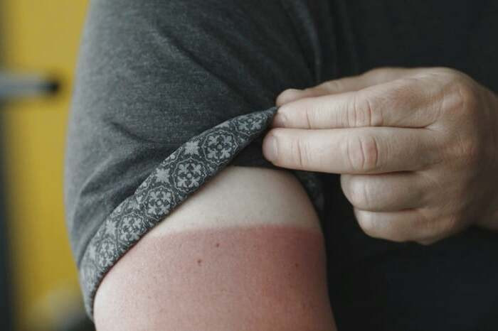 سیب زمینی برای درمان آفتاب سوختگی  درمان آفتاب سوختگی با سیب زمینی