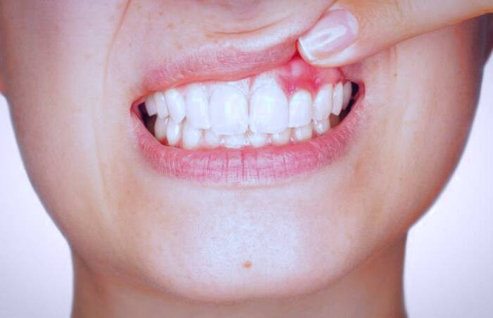 زخم های دهان