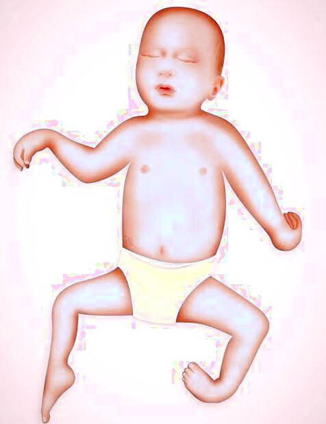 آرتروگریپوزیس کودکان