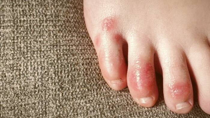 مشکلات پوستی کرونا