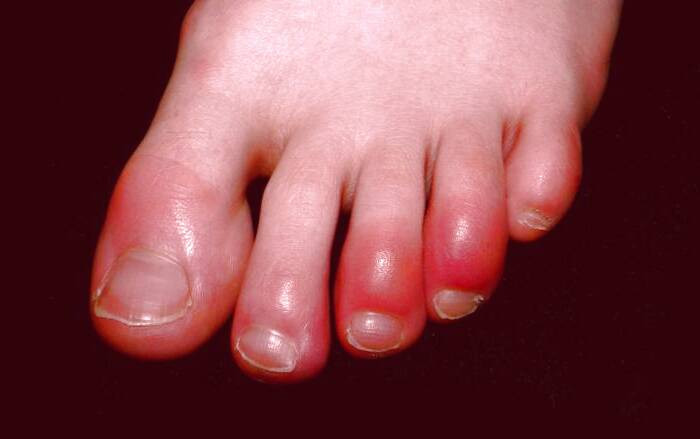 انگشت پای کوویدی