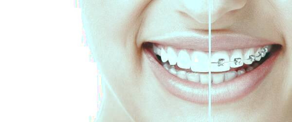 بهترین ارتودنسی دندان