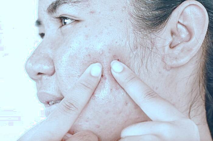 جوش روی گونه