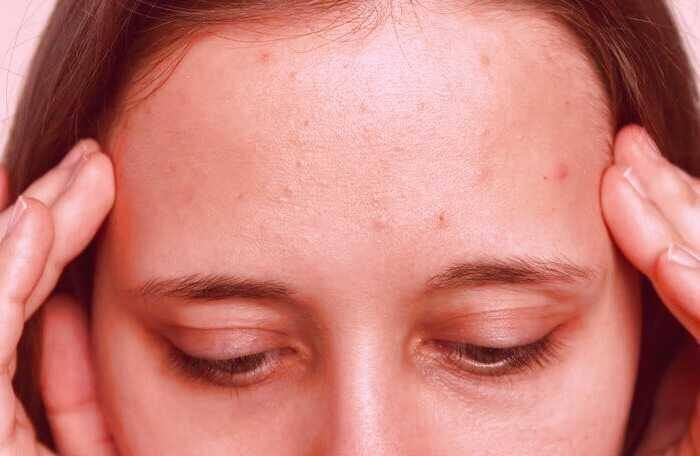 جوش روی پیشانی