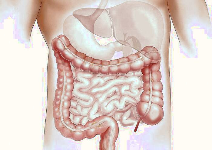 انسداد روده