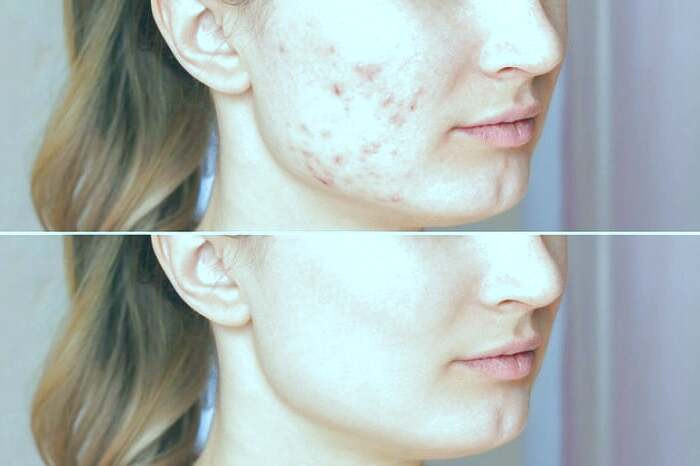 آکنه های شدید