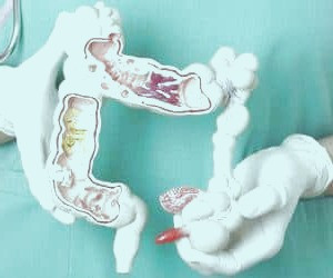 بررسی دیورتیکولیت و دیورتیکولوز: از علل و نشانه‌ها تا تشخیص و درمان