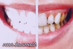 بهبود وضعیت دندان‌ها با خدمات جرمگیری