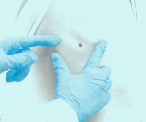 سرطان ملانوما: شناسایی علائم کلیدی و رویکردهای تشخیصی و درمانی