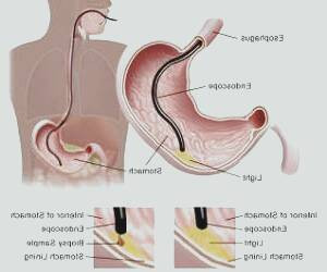 بهبود روش های مراقبت قبل و پس از آندوسکوپی معده در کودکان