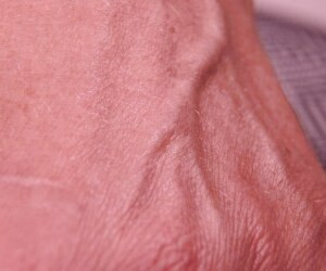 بررسی علائم آمبولی و راه های پیشگیری از آن