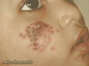 بازیابی سریع از عفونت سالک