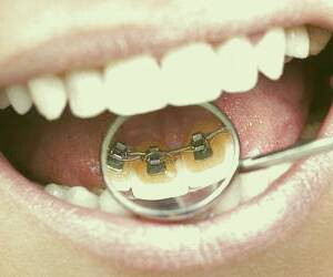 بهترین زمان برای مراجعه به دندانپزشک ارتودنتیست