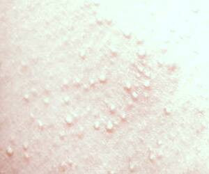 مولوسکوم در کودکان و بزرگسالان: علل و درمان