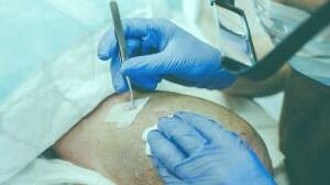 کاشت و موی سر در کلینیک معتبر با تصاویر