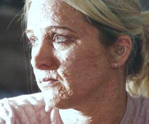 عوامل و نشانه‌های انواع نوروفیبروماتوز + تشخیص و درمان