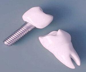 ایمپلنت دندان: راهکاری مؤثر برای دندان‌های از دست رفته