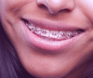 بهبود موقعیت دندان ها با درمان ارتودنسی